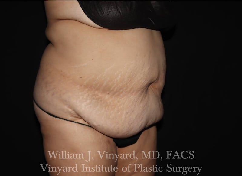 Tummy Tuck Before & After Gallery - Patient 169942238 - Image 3