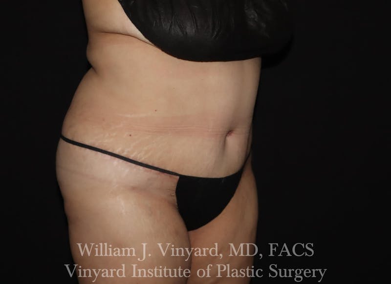 Tummy Tuck Before & After Gallery - Patient 169942238 - Image 4