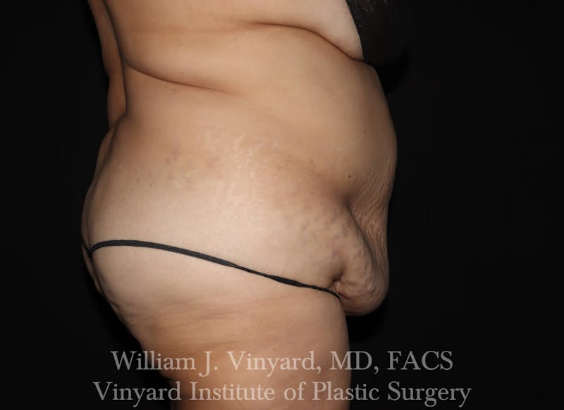 Tummy Tuck Before & After Gallery - Patient 169942238 - Image 5