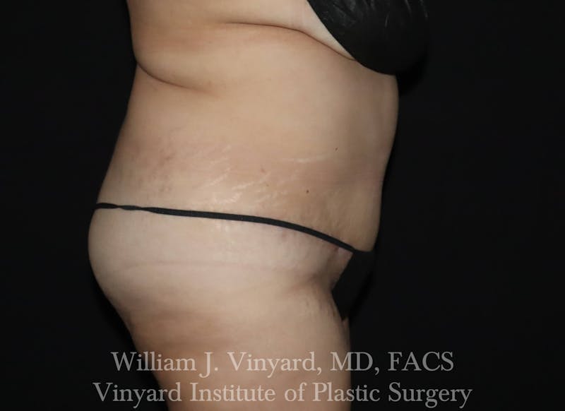 Tummy Tuck Before & After Gallery - Patient 169942238 - Image 6