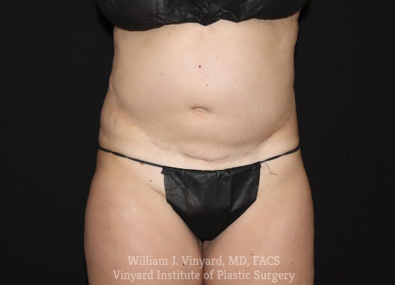 Tummy Tuck Before & After Gallery - Patient 169942240 - Image 1