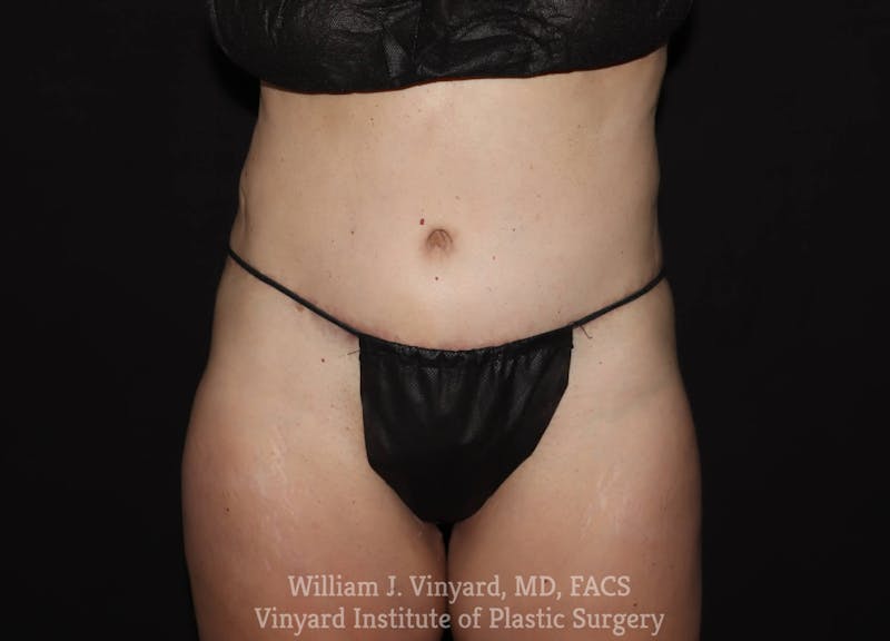 Tummy Tuck Before & After Gallery - Patient 169942240 - Image 2