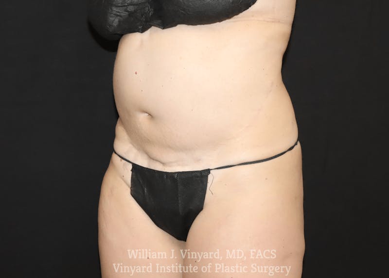 Tummy Tuck Before & After Gallery - Patient 169942240 - Image 3