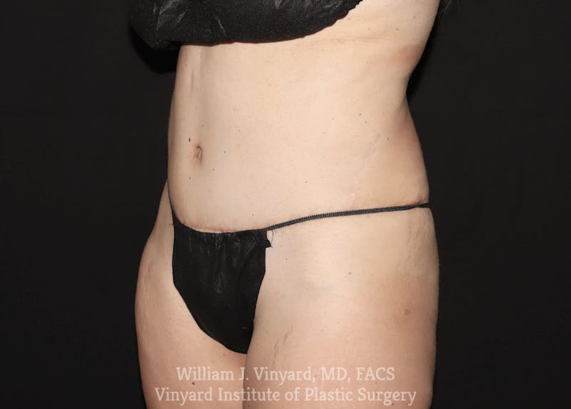 Tummy Tuck Before & After Gallery - Patient 169942240 - Image 4