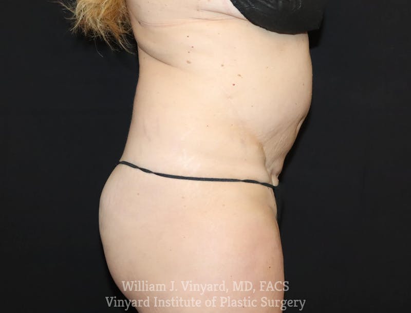 Tummy Tuck Before & After Gallery - Patient 169942240 - Image 5