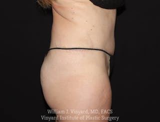 Tummy Tuck Before & After Gallery - Patient 169942240 - Image 6