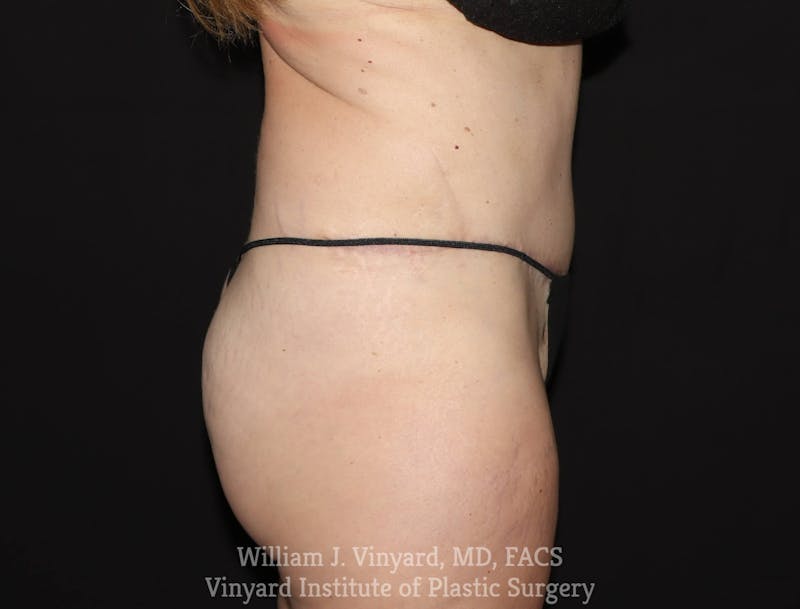 Tummy Tuck Before & After Gallery - Patient 169942240 - Image 6
