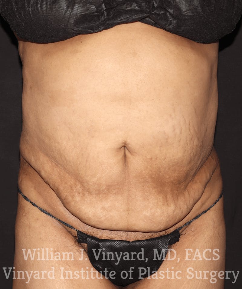 Tummy Tuck Before & After Gallery - Patient 169942241 - Image 1