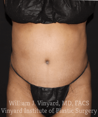 Tummy Tuck Before & After Gallery - Patient 169942241 - Image 2