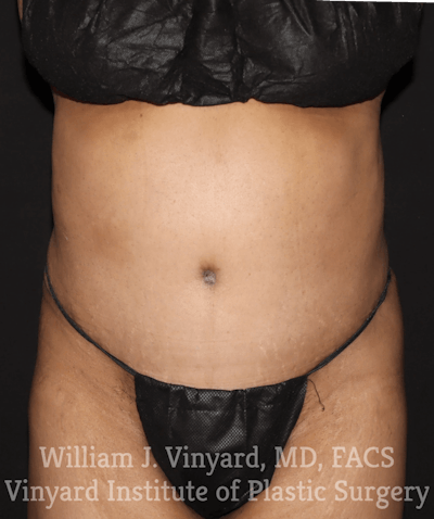 Tummy Tuck Before & After Gallery - Patient 169942241 - Image 2