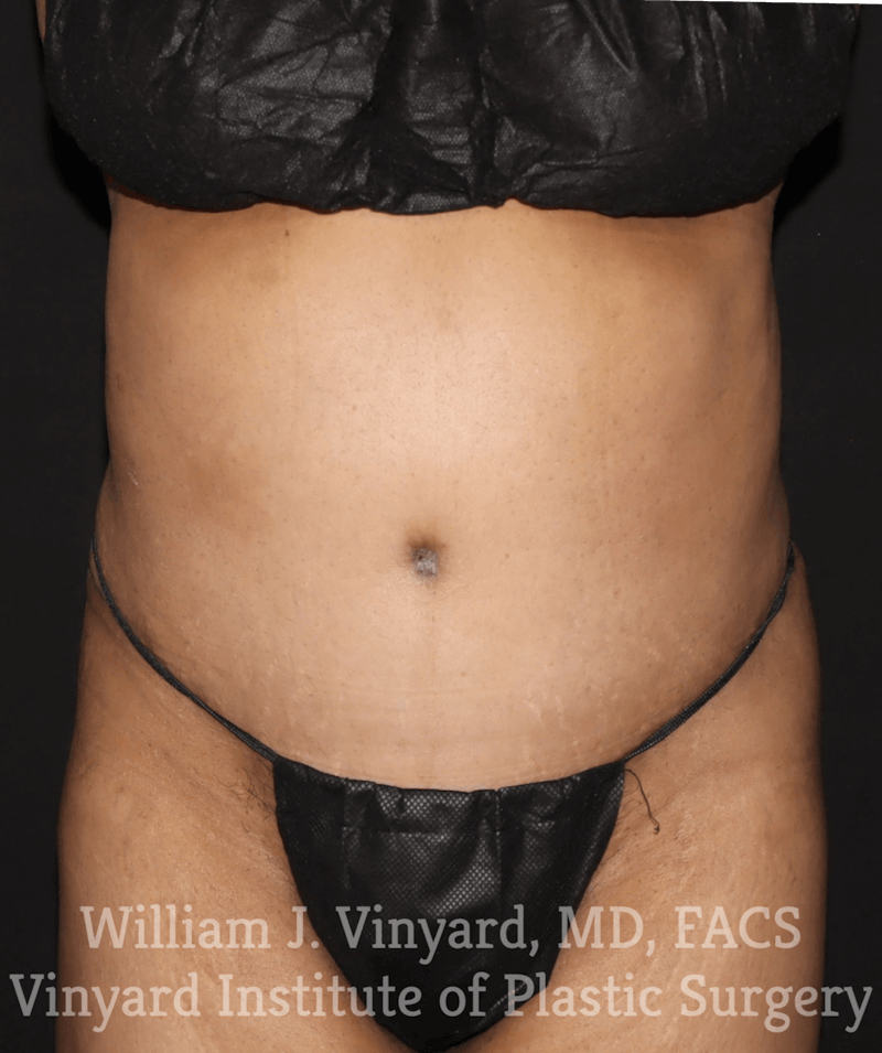 Tummy Tuck Before & After Gallery - Patient 169942241 - Image 2