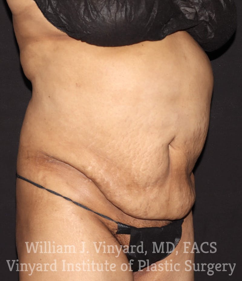 Tummy Tuck Before & After Gallery - Patient 169942241 - Image 3