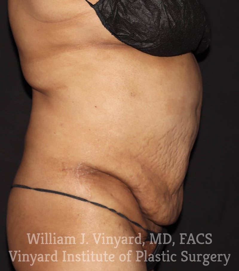 Tummy Tuck Before & After Gallery - Patient 169942241 - Image 5