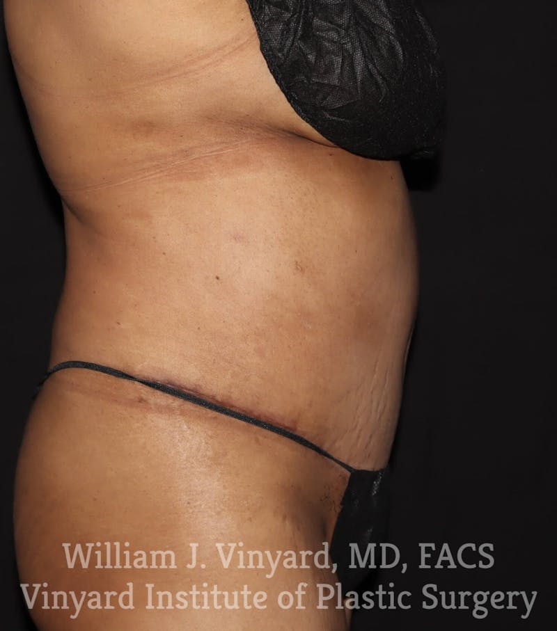 Tummy Tuck Before & After Gallery - Patient 169942241 - Image 6