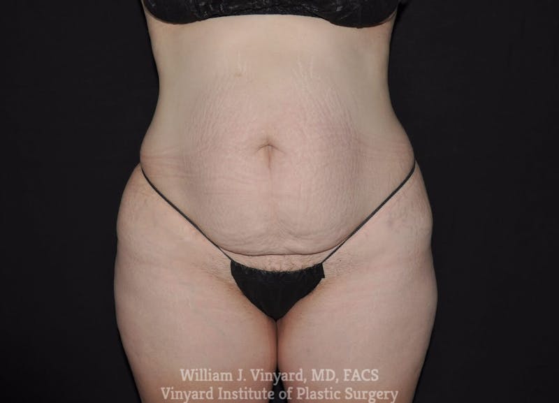 Tummy Tuck Before & After Gallery - Patient 169942242 - Image 1