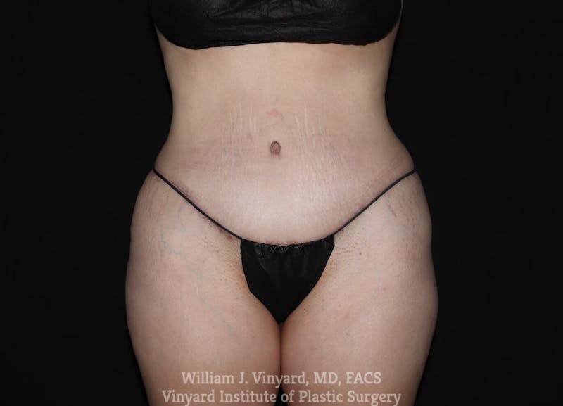 Tummy Tuck Before & After Gallery - Patient 169942242 - Image 2