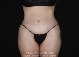 Tummy Tuck Before & After Gallery - Patient 169942242 - Image 2