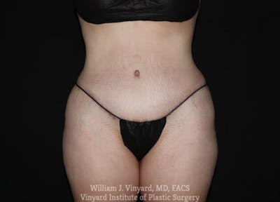 Tummy Tuck Before & After Gallery - Patient 169942242 - Image 2