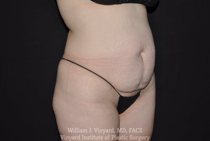 Tummy Tuck Before & After Gallery - Patient 169942242 - Image 3