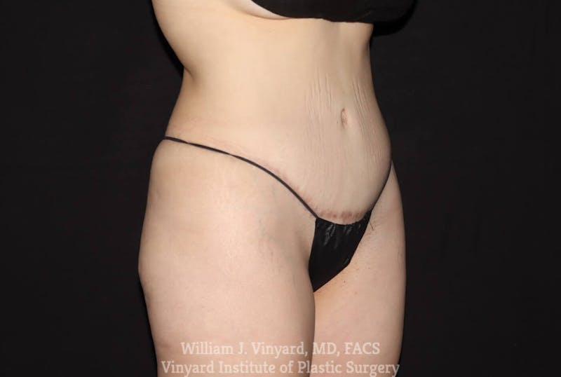 Tummy Tuck Before & After Gallery - Patient 169942242 - Image 4