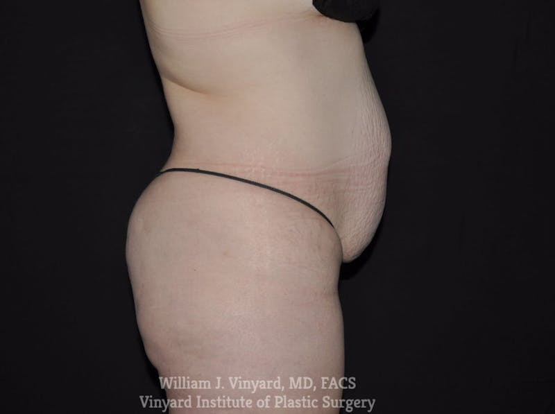 Tummy Tuck Before & After Gallery - Patient 169942242 - Image 5