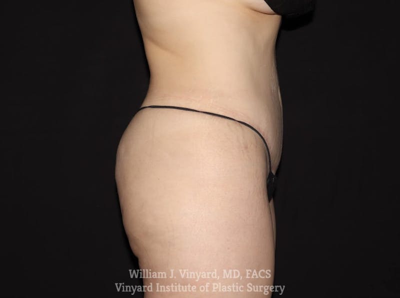Tummy Tuck Before & After Gallery - Patient 169942242 - Image 6