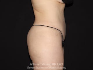 Tummy Tuck Before & After Gallery - Patient 169942242 - Image 6