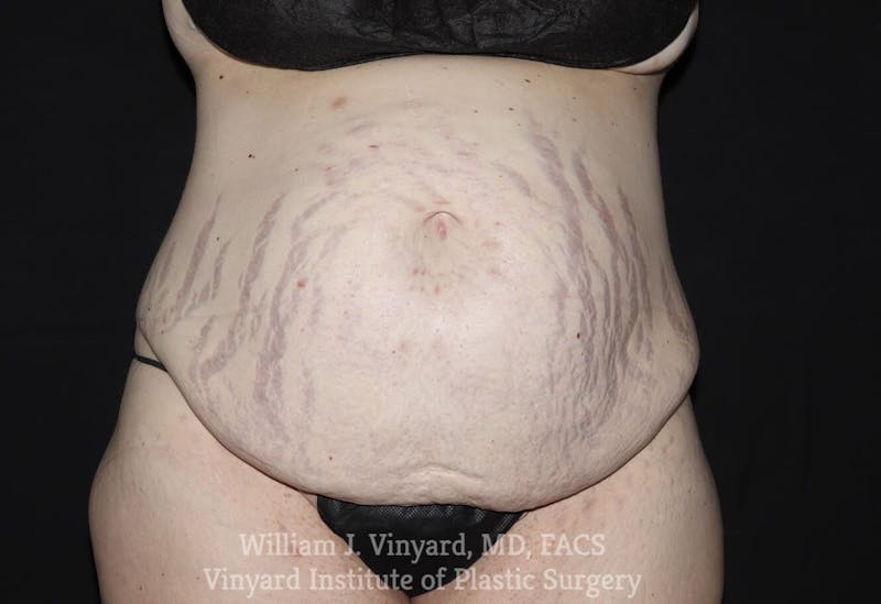 Tummy Tuck Before & After Gallery - Patient 169942278 - Image 1