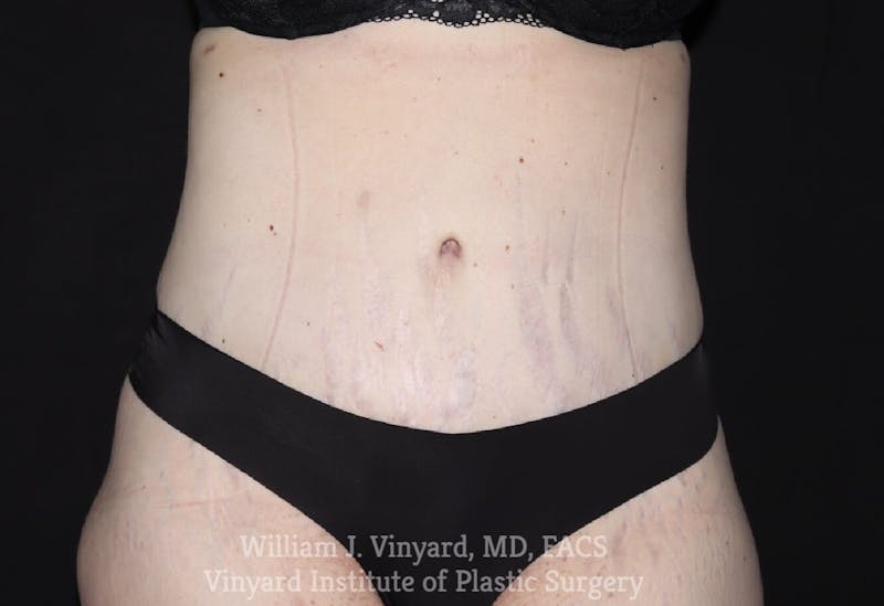 Tummy Tuck Before & After Gallery - Patient 169942278 - Image 2