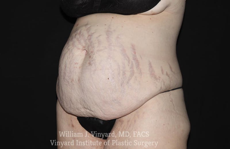 Tummy Tuck Before & After Gallery - Patient 169942278 - Image 3