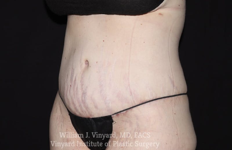 Tummy Tuck Before & After Gallery - Patient 169942278 - Image 4