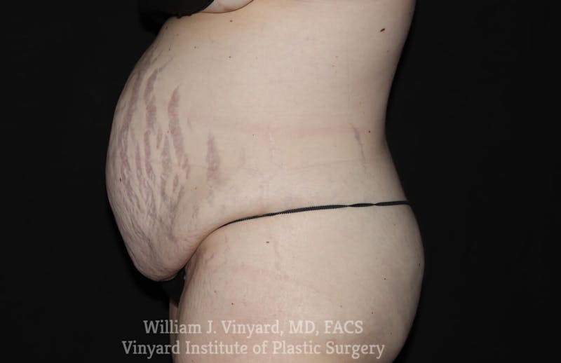 Tummy Tuck Before & After Gallery - Patient 169942278 - Image 5