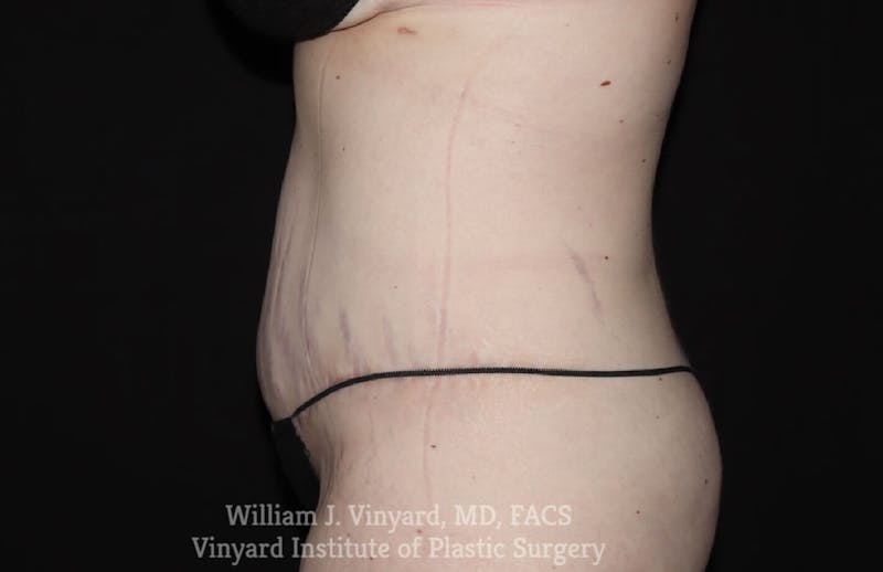 Tummy Tuck Before & After Gallery - Patient 169942278 - Image 6