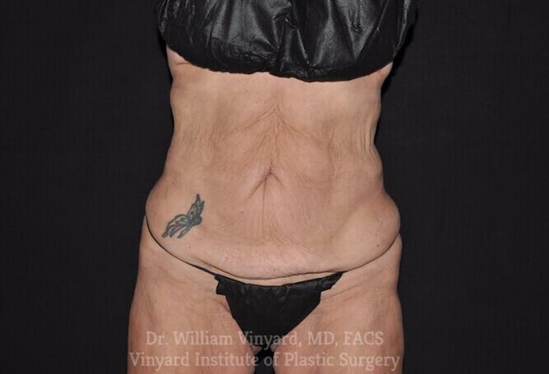 Tummy Tuck Before & After Gallery - Patient 169942677 - Image 1