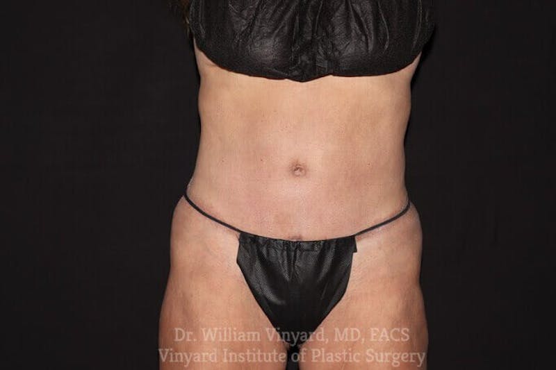 Tummy Tuck Before & After Gallery - Patient 169942677 - Image 2