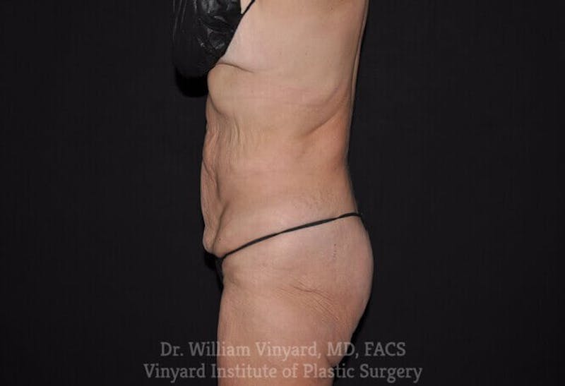 Tummy Tuck Before & After Gallery - Patient 169942677 - Image 3
