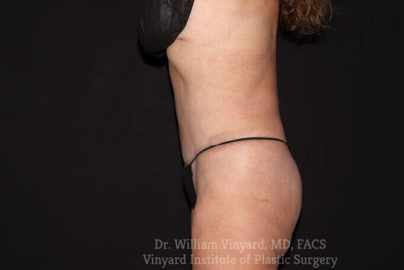 Tummy Tuck Before & After Gallery - Patient 169942677 - Image 4
