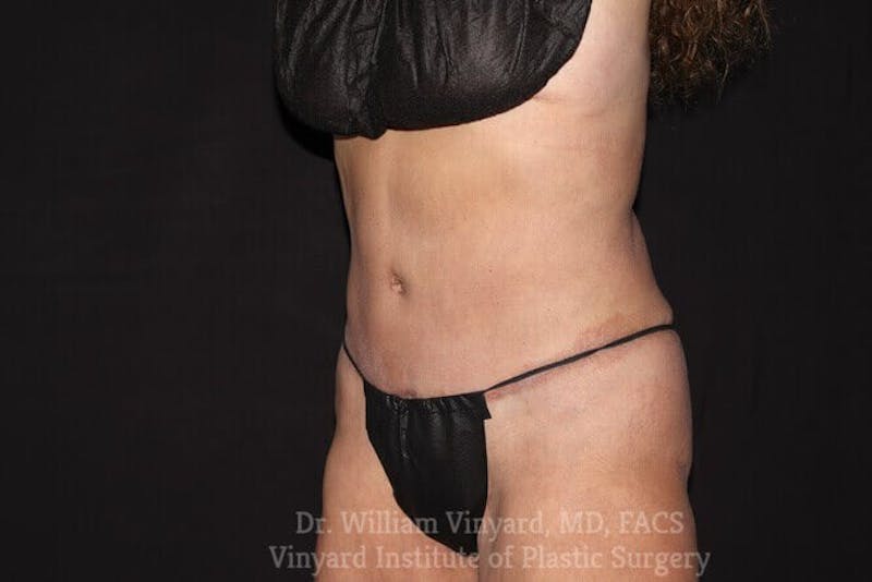 Tummy Tuck Before & After Gallery - Patient 169942677 - Image 6