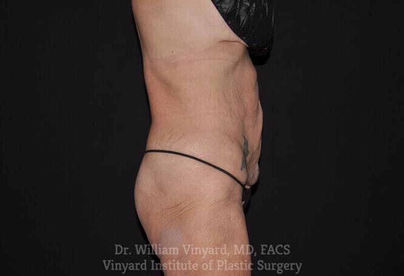 Tummy Tuck Before & After Gallery - Patient 169942677 - Image 9