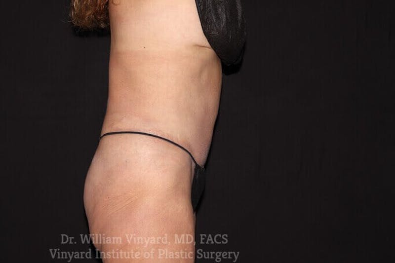 Tummy Tuck Before & After Gallery - Patient 169942677 - Image 10