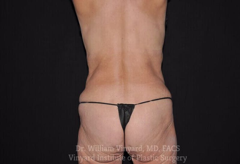 Tummy Tuck Before & After Gallery - Patient 169942677 - Image 11