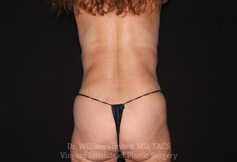 Tummy Tuck Before & After Gallery - Patient 169942677 - Image 12