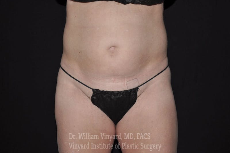 Tummy Tuck Before & After Gallery - Patient 169942782 - Image 1