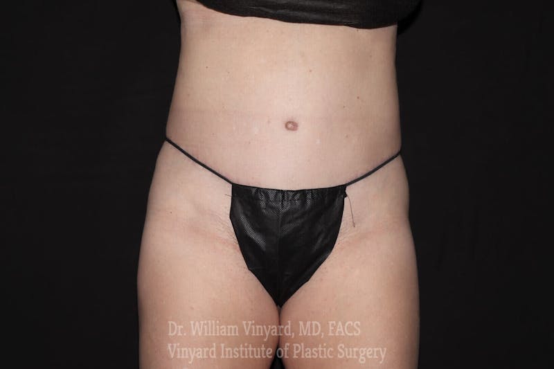 Tummy Tuck Before & After Gallery - Patient 169942782 - Image 2
