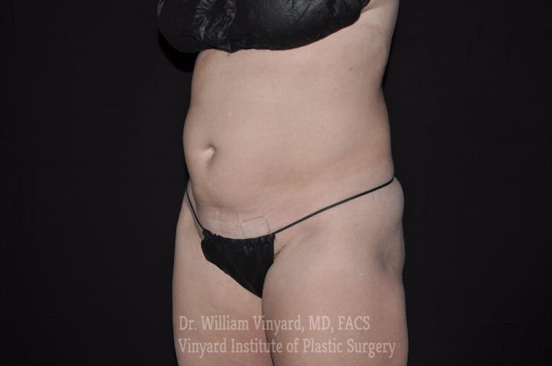 Tummy Tuck Before & After Gallery - Patient 169942782 - Image 3