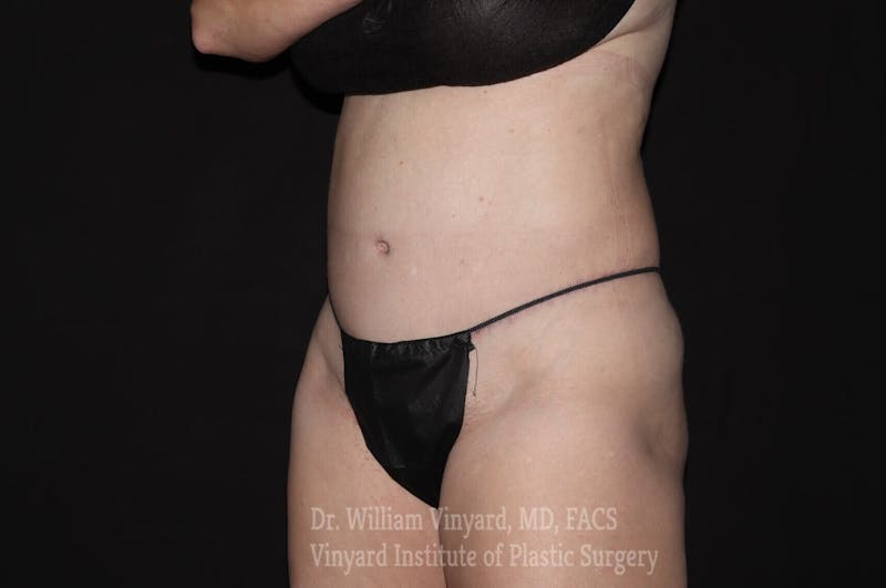 Tummy Tuck Before & After Gallery - Patient 169942782 - Image 4