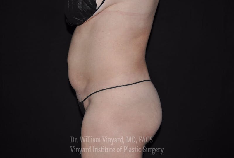 Tummy Tuck Before & After Gallery - Patient 169942782 - Image 5