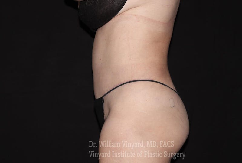 Tummy Tuck Before & After Gallery - Patient 169942782 - Image 6