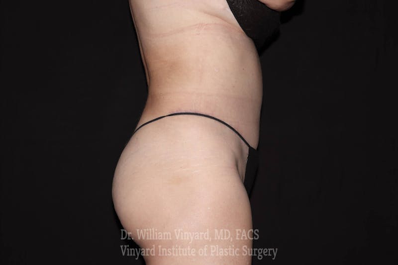 Tummy Tuck Before & After Gallery - Patient 169942782 - Image 8