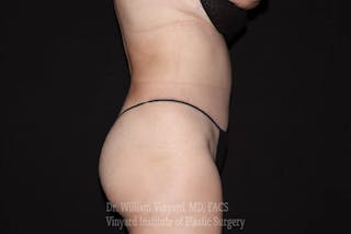 Tummy Tuck Before & After Gallery - Patient 169942782 - Image 8